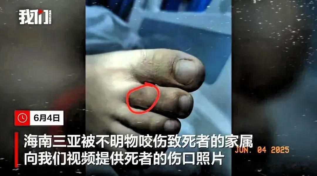 三亚被蛇咬死的美女真冤！三亚被蛇咬伤女游客的伤口照片曝光，被咬到的是右脚第二根