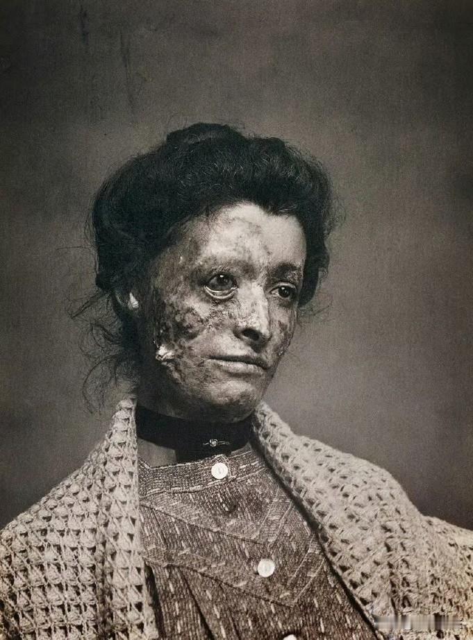 老照片欣赏：摄于约十九世纪七十年代，国外一女性梅毒患者；只见她眼神空洞，忧愁