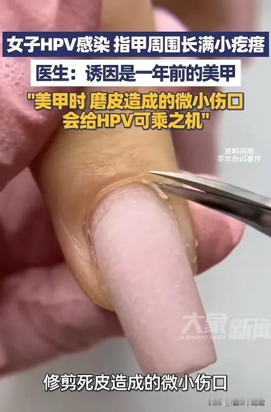 “太吓人了！”5月9日报道，浙江杭州，一女子发现她的指甲周边，长了许多粗糙坚硬的
