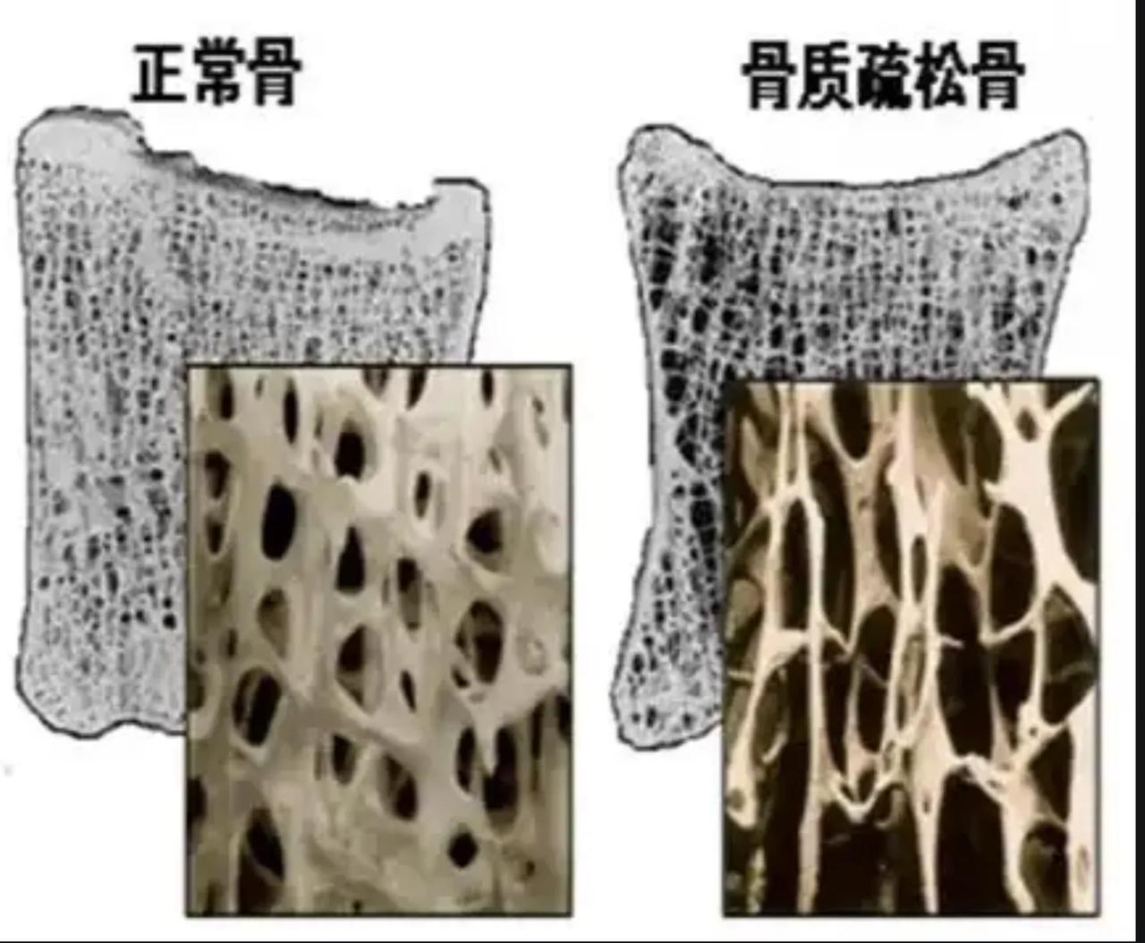 骨质疏松对于女性可能是致命的我的姑姑年轻时长期生活在北京，年轻的时候她是个单位