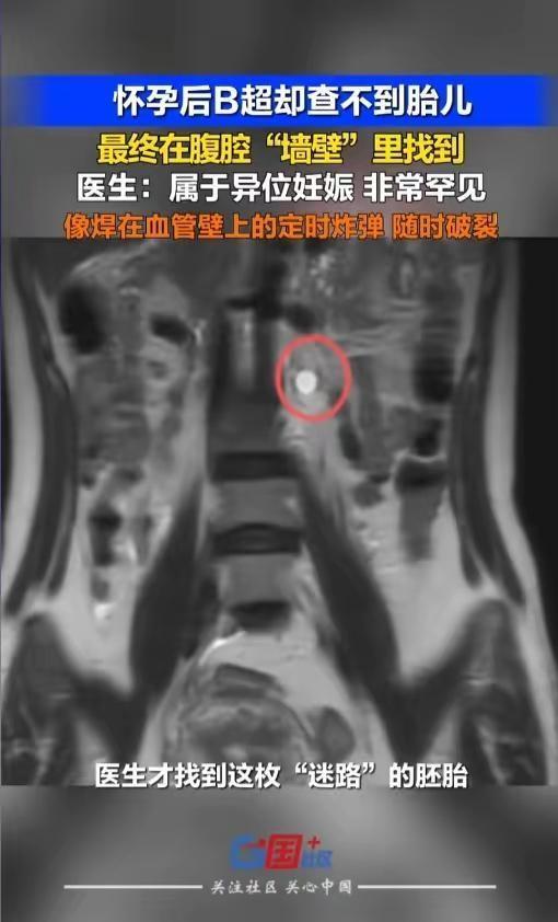 “太惊险了！”5月7日据报道，深圳一女子确证怀孕可B超却寻不到胎儿，直到通过CT