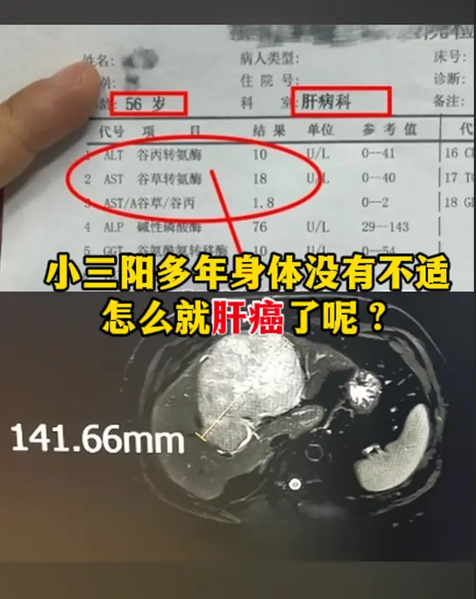 小三阳多年身体没有不适怎么就肝癌了呢？。作为一名从事肝病工作30多年的...