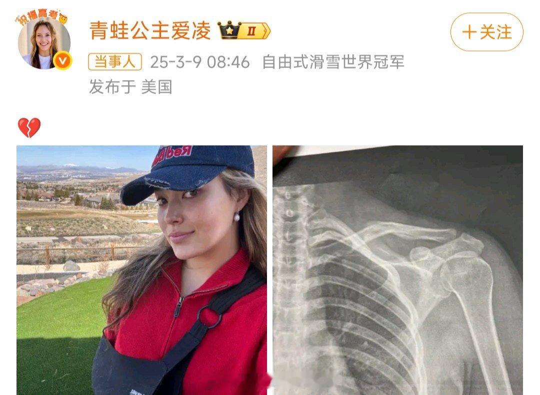 谷爱凌锁骨受伤谷爱凌更新社媒发布锁骨骨折的X光片，运动员真是不容易，好好休养，