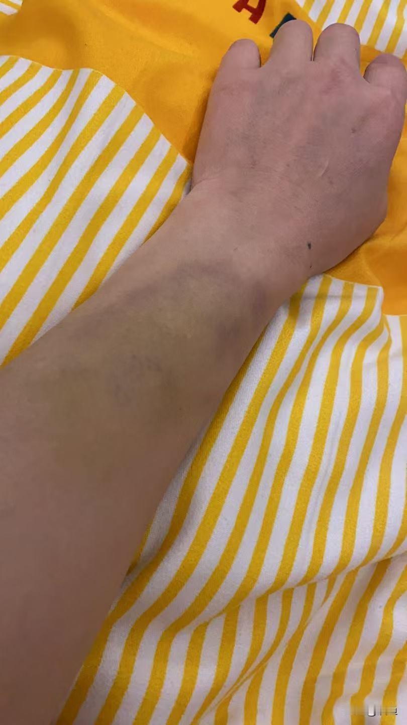 今晚听说我那个32岁直肠癌的朋友从北京回来了在北京只做了个直肠造瘘术现在回