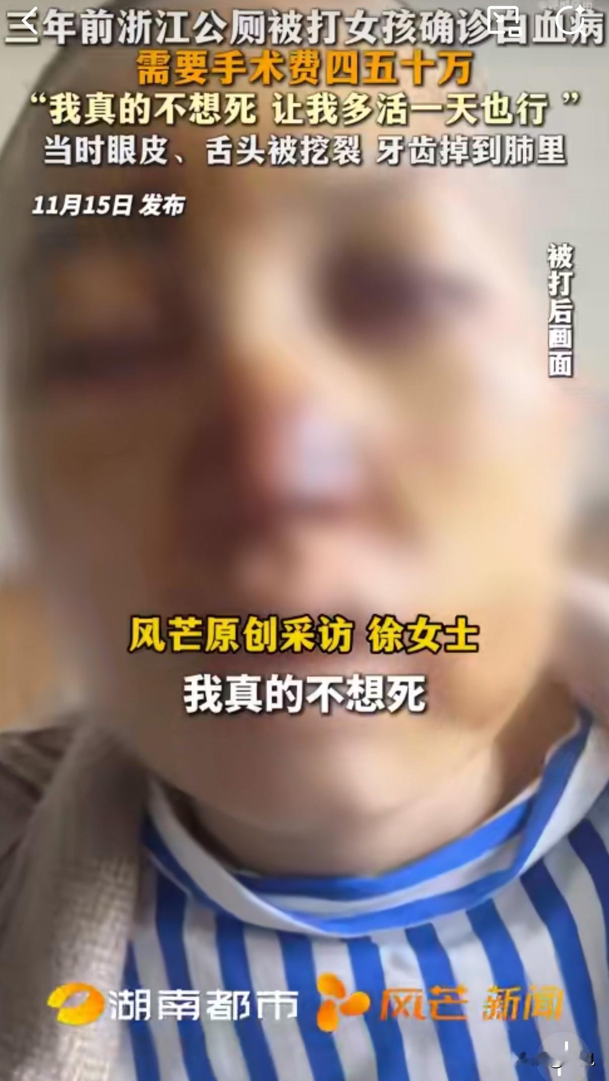 浙江女孩公厕无端被打成重伤，后遗症还没好，现在又确诊白血病。厄运像认准了她，一次