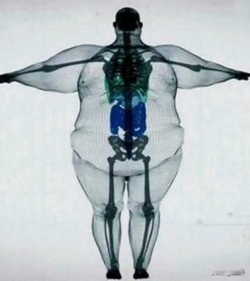 这张3D渲染图直观揭露了极度肥胖对人体的毁灭性影响，基思·马丁的案例更是成为肥胖