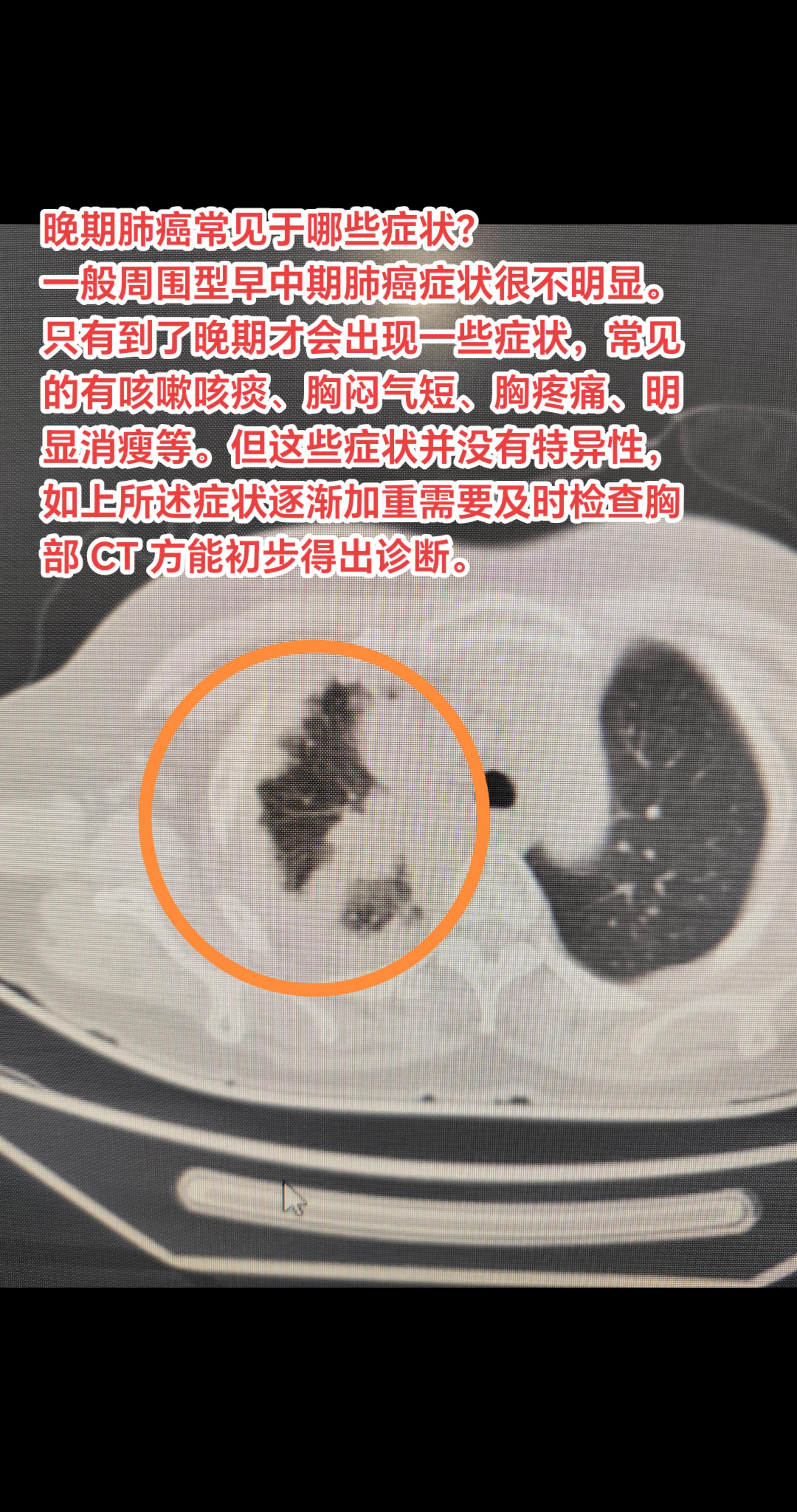 晚期肺癌常见于哪些症状？一般周围型早中期肺癌症状很不明显。只有到了晚期...