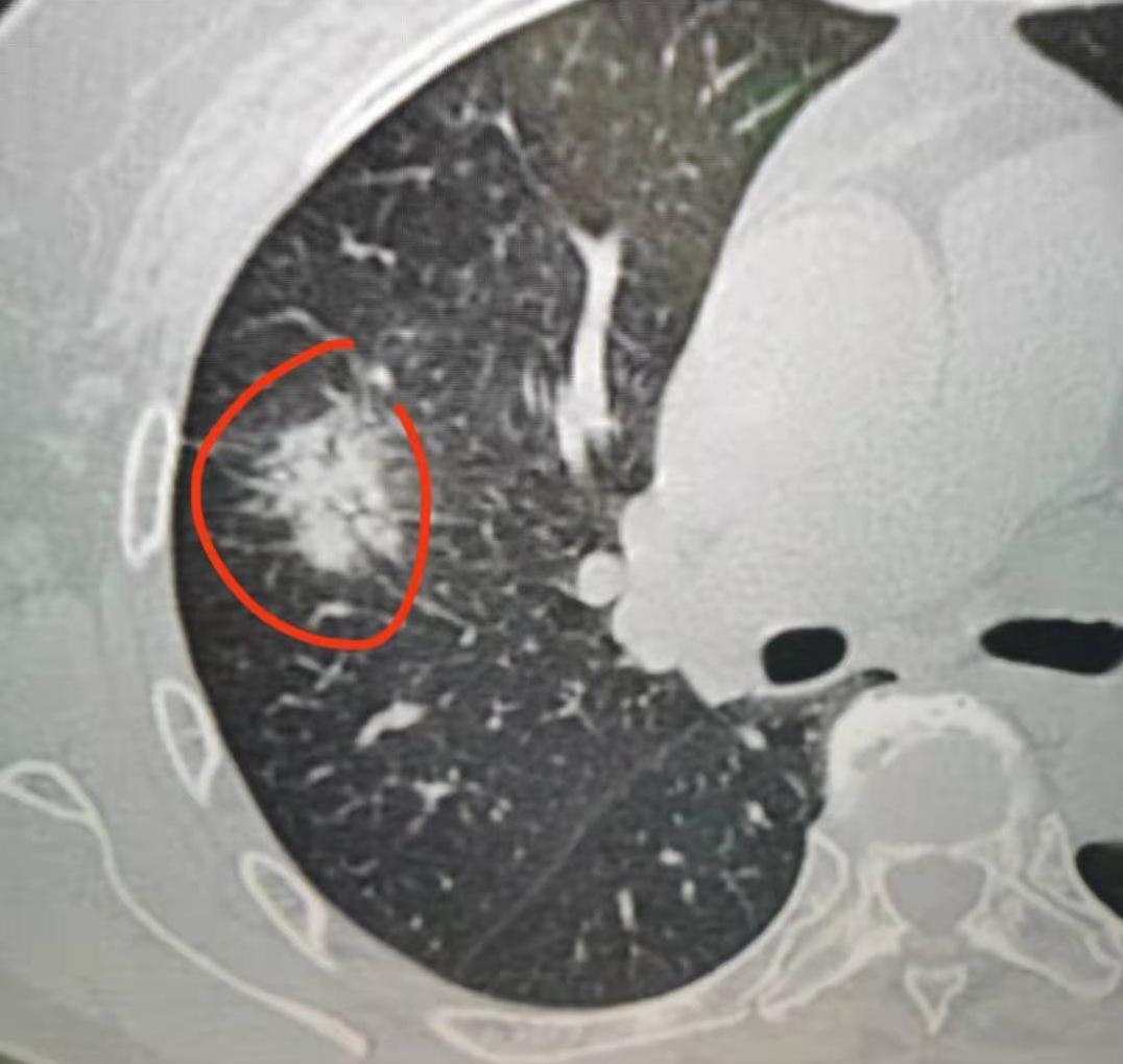 肺癌3A期局部晚期”就是癌细胞出现了纵隔淋巴结转移，简单说，就是肺里的癌细胞，通