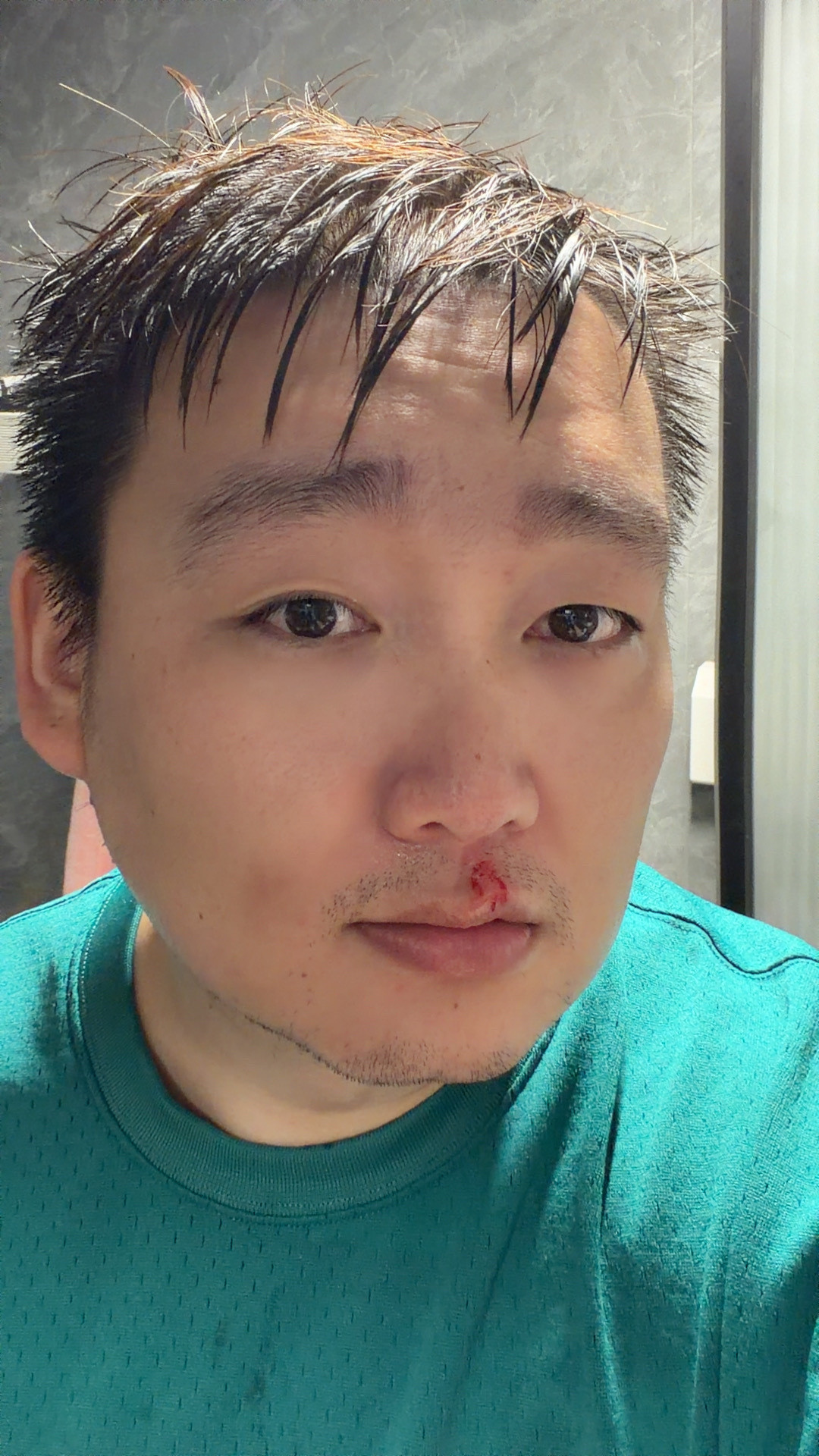 洗头抬头太快，被水龙头破相了....