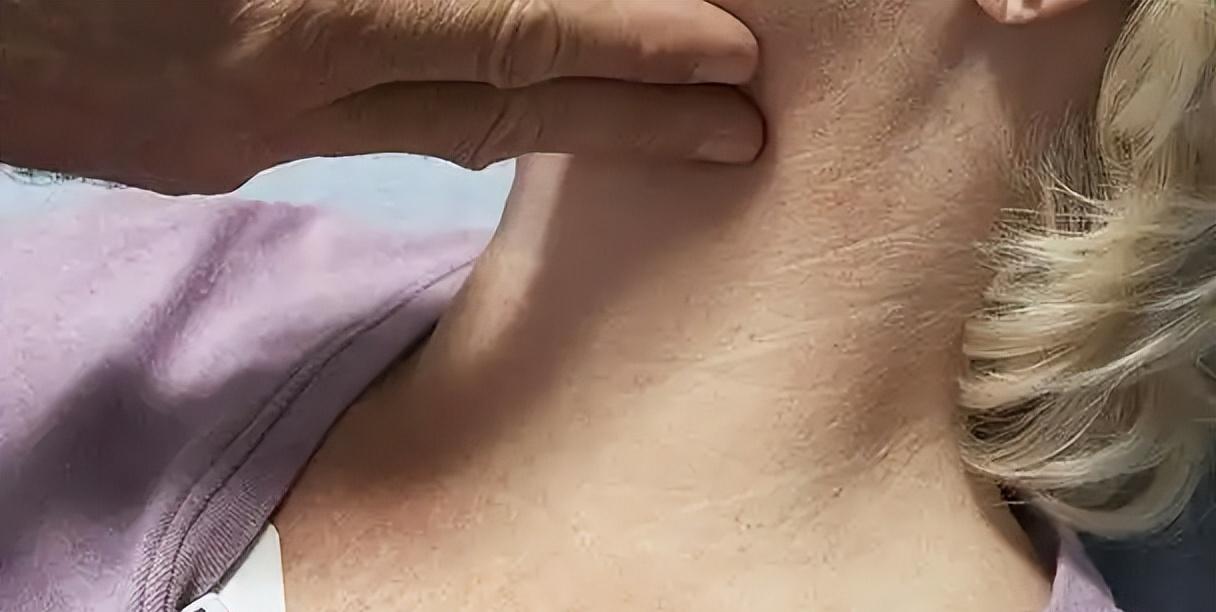 颈动脉斑块这玩意儿，50岁一过就炸雷了——千万体检数据砸下来，标化检出率直奔21