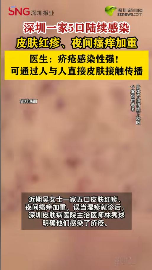 “一感染就是一家子！”6月29日报道，广东深圳，一家五口陆陆续续皮肤都起了红疹，