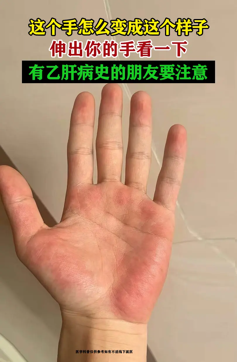 这是肝掌。手掌大小鱼际出现这种发红，很可能是肝掌，约70%的肝硬化患者...