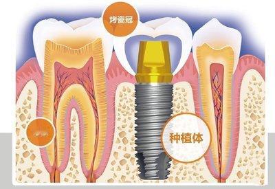 表哥牙坏了几颗，医生说种一颗牙要3到6个月的时间，几颗牙要几年才能种完。几年过后