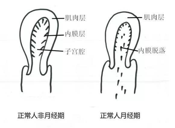 子宫腺肌症为何会痛经? 这是有原因的