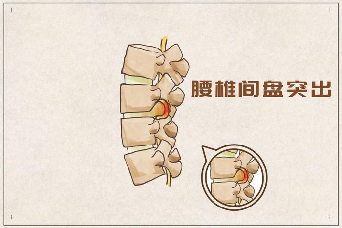 很多患者问我，椎间盘为什么会突出？中医辩证分析：5种常见证型，对照看看，你是属于