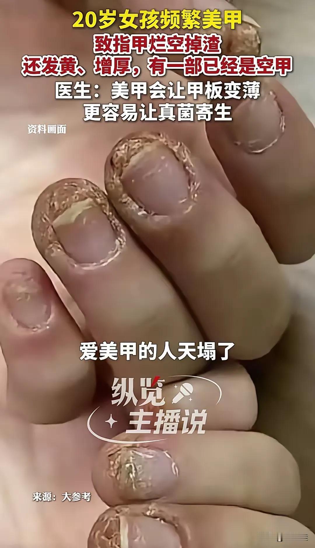 你以为这是农民的手，错了！这是个20岁姑娘的手，就因为频繁做美甲，指甲烂得空了、