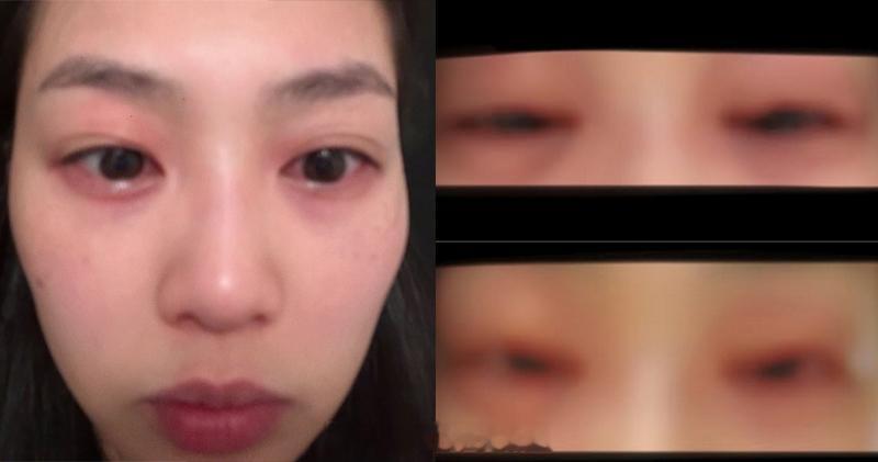 郭柏妍严重食物敏感脸肿面目全非：气管收缩抖唔到气2020年港姐季军郭柏妍是不少粉