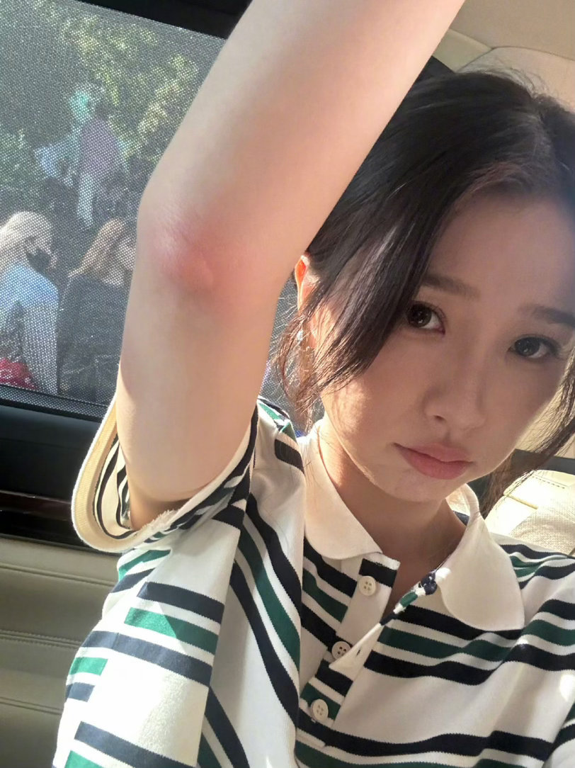 咋这么大一个蚊子包