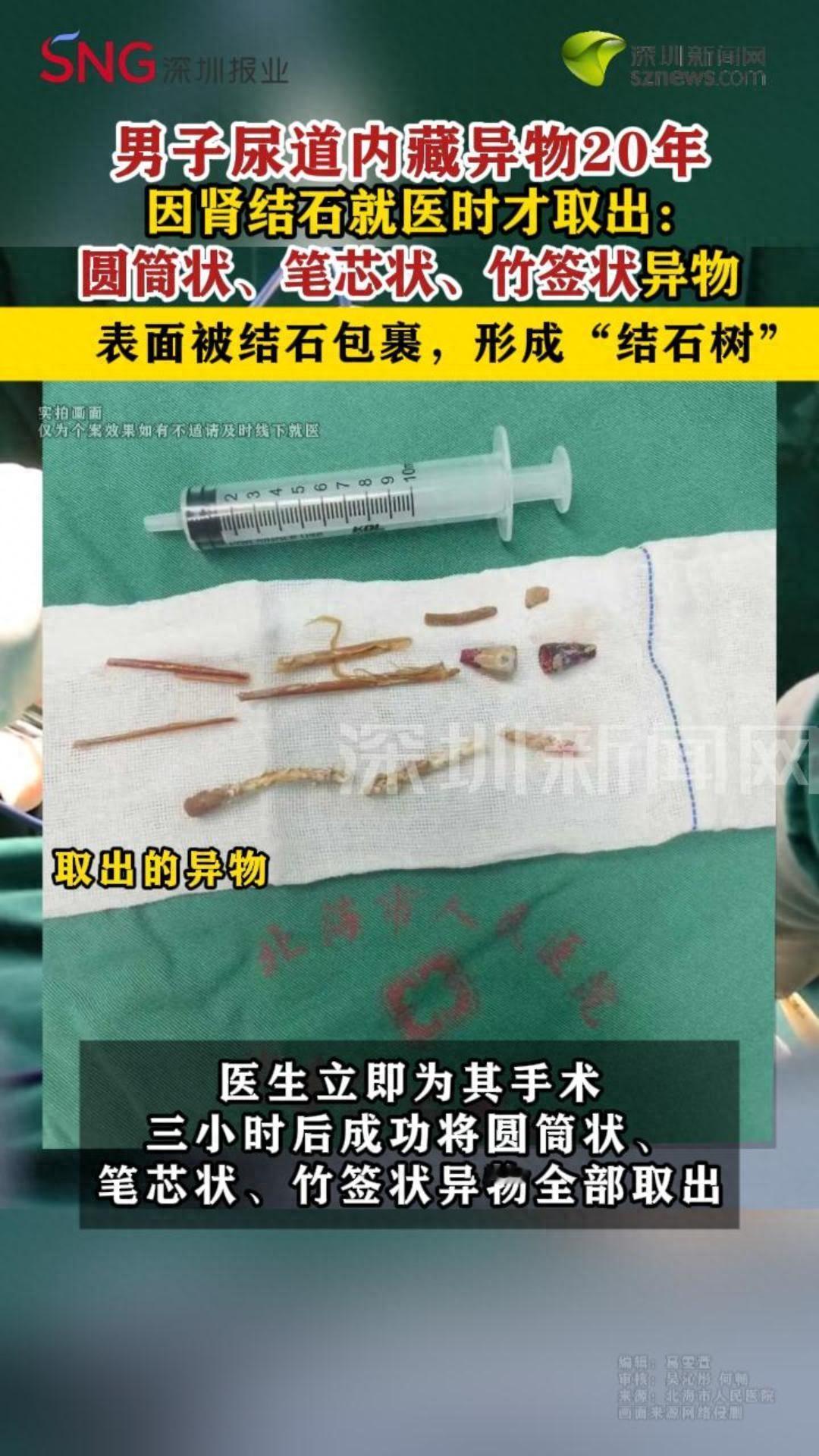 这是个狠人！广西北海，一名男子因为肾结石合并肾脏脓肿去医院检查，结果医生发现了让