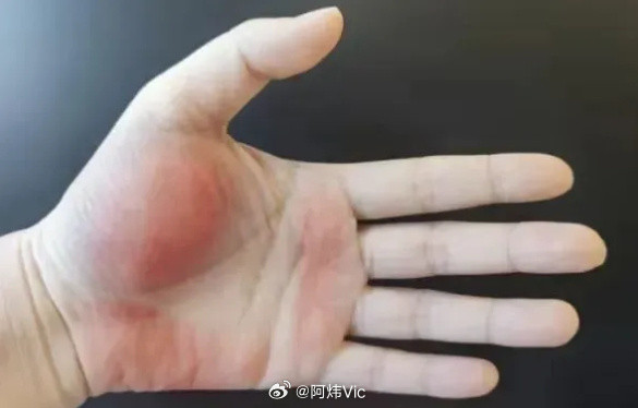 【肝脏预警信号一黄二红三黑】身上出现一黄二红三黑要查肝肝脏很能“忍”，有时候明