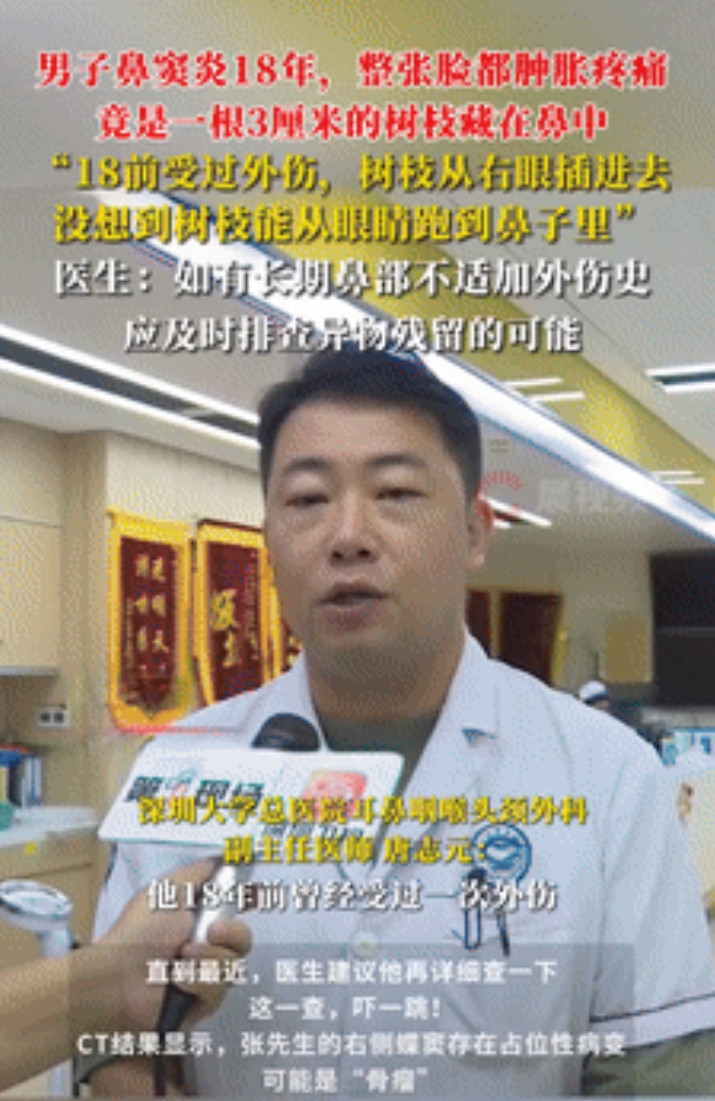 活久见！广东一男子常年鼻塞和流鼻血，去了无数次医院，医生都说是鼻窦炎，但每次治疗