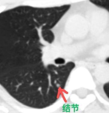 一位29岁的患者，已经做手术切了5个肺结节，左上肺还留着一个7mm肺磨玻璃结节，