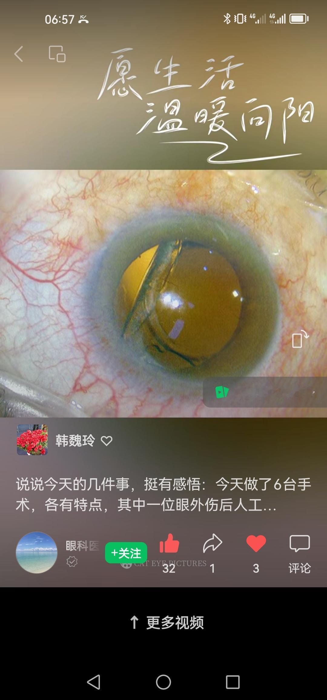 说说今天的几件事，挺有感悟。今天做了6台手术，各有特点，其中一位眼外伤后人工晶
