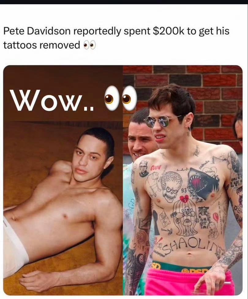 纹身一时爽，美国脱口秀艺人皮特·戴维森为清除胸前的纹身，已经花了20万美金，