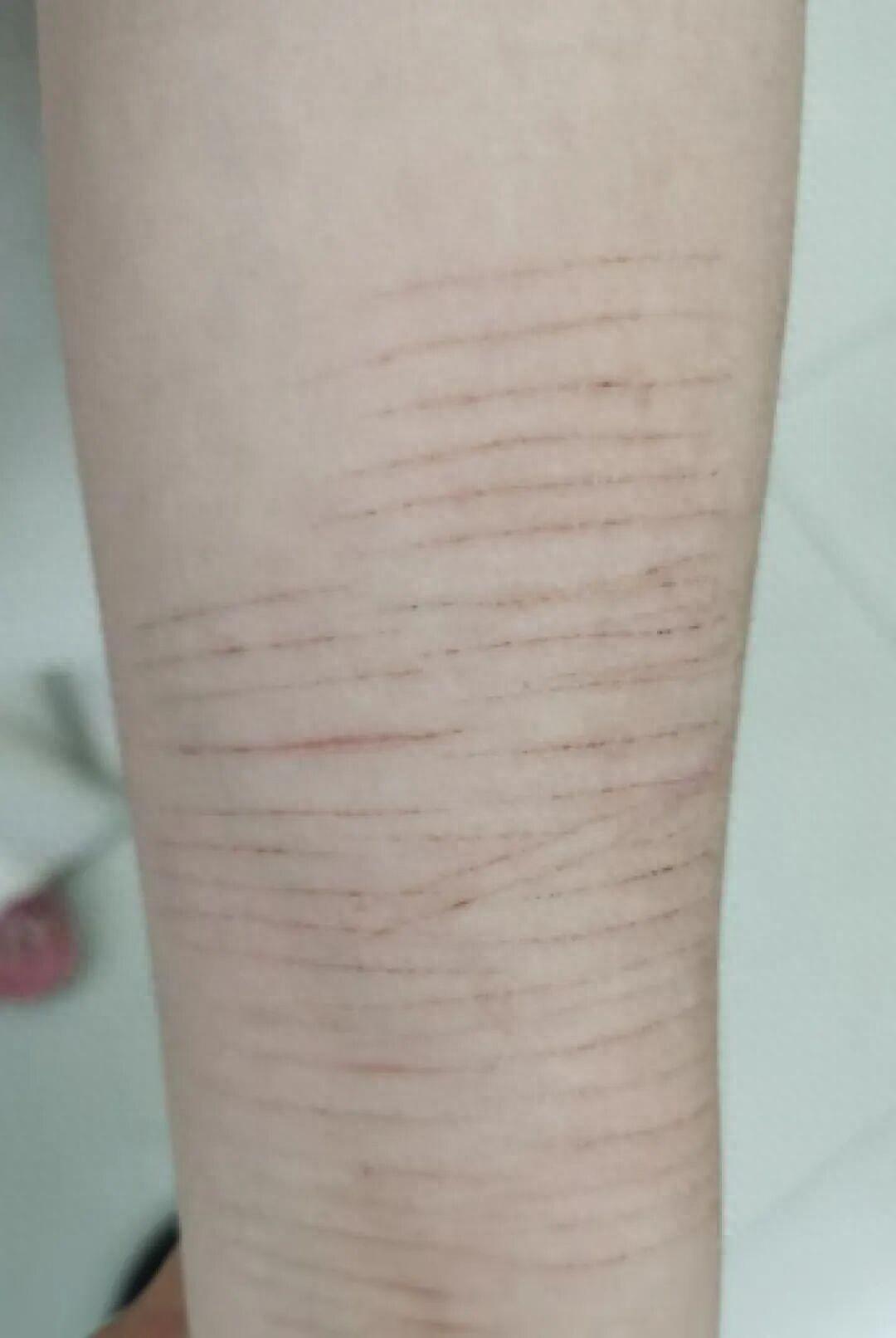 郑州14岁女生胳膊上满是划痕，老师坚持让家长带去看病，家长却说“她能吃能睡没问题