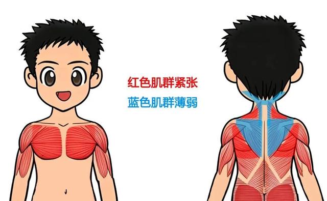 圆肩驼背、肩颈酸痛? 你的上交叉综合症有救了