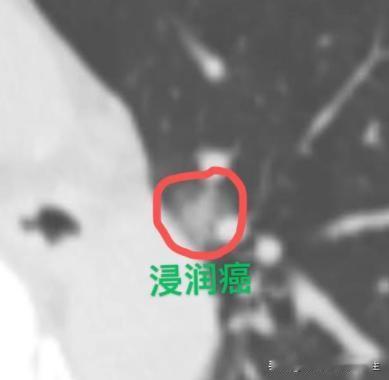 肺浸润癌又是低分化、有高危因素！是不是很危险会复发？很多患者做完手术后，一看到病