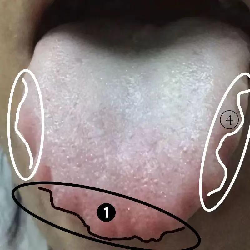 中医消齿痕最快的4大妙法，舌尖到舌根，祛湿气，断根不反复！①舌尖齿痕明显→