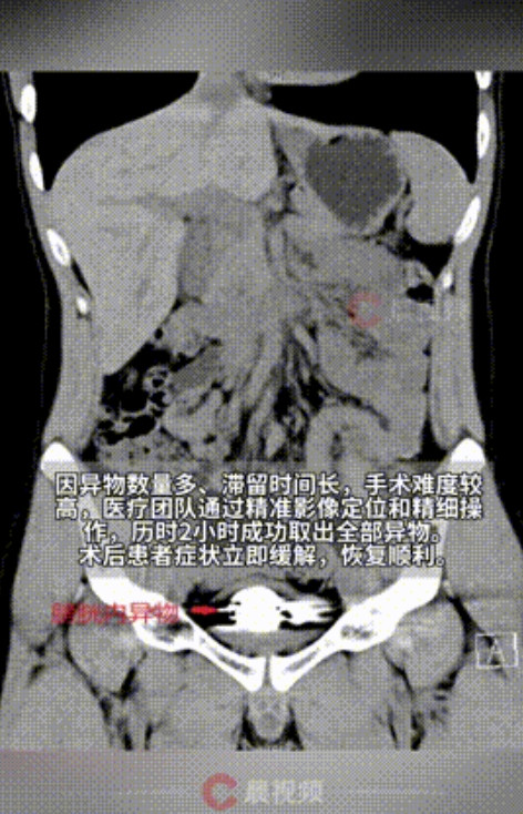 林子大了什么鸟都有！”湖南长沙，一22岁男子尿急尿痛长达1年时间，实在忍无可忍到