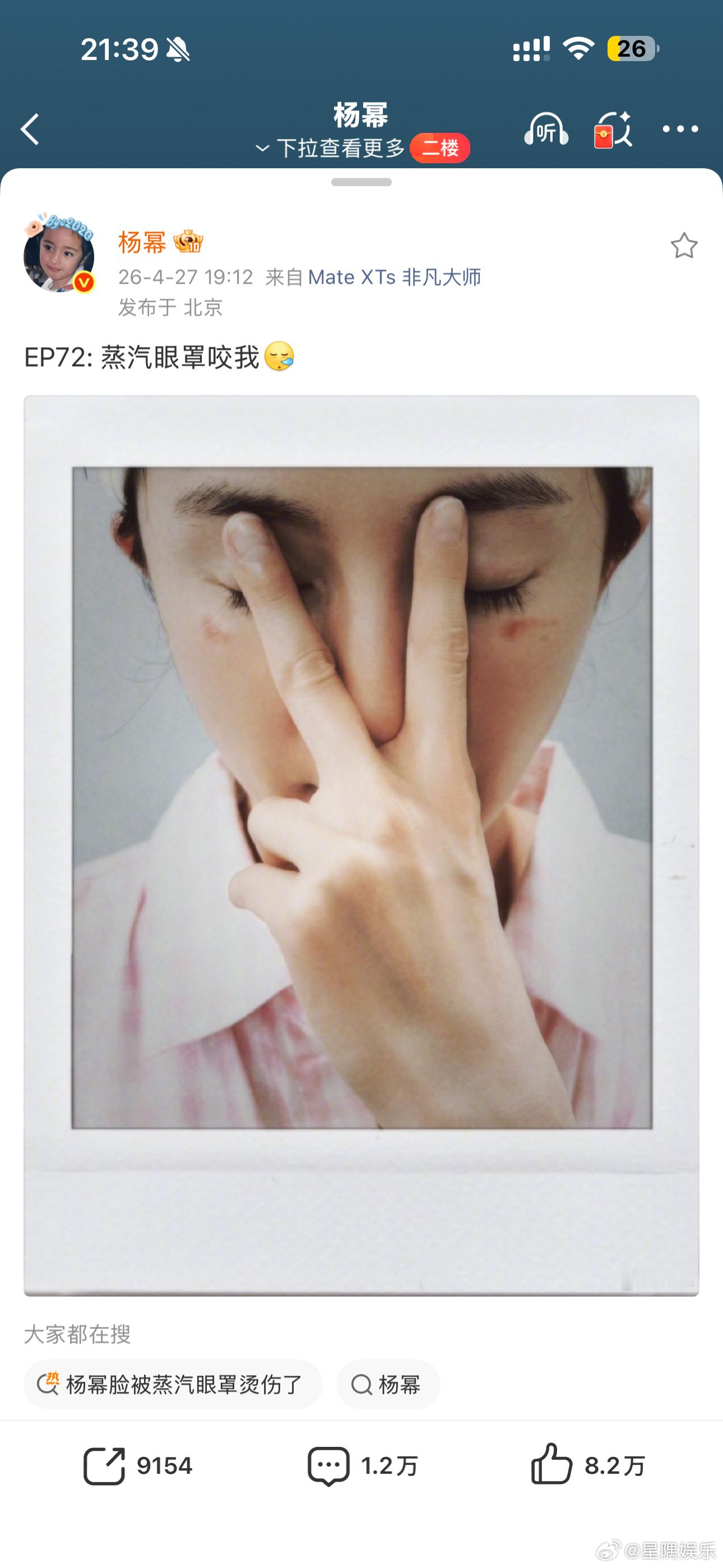 张馨予评论杨幂蒸汽眼罩烫伤，太有心了