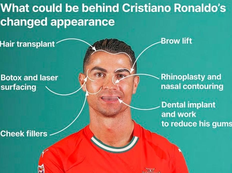 实锤了！整形医生确定40岁的C罗进行过多次面部整形！从鼻子，牙齿，面容等，多