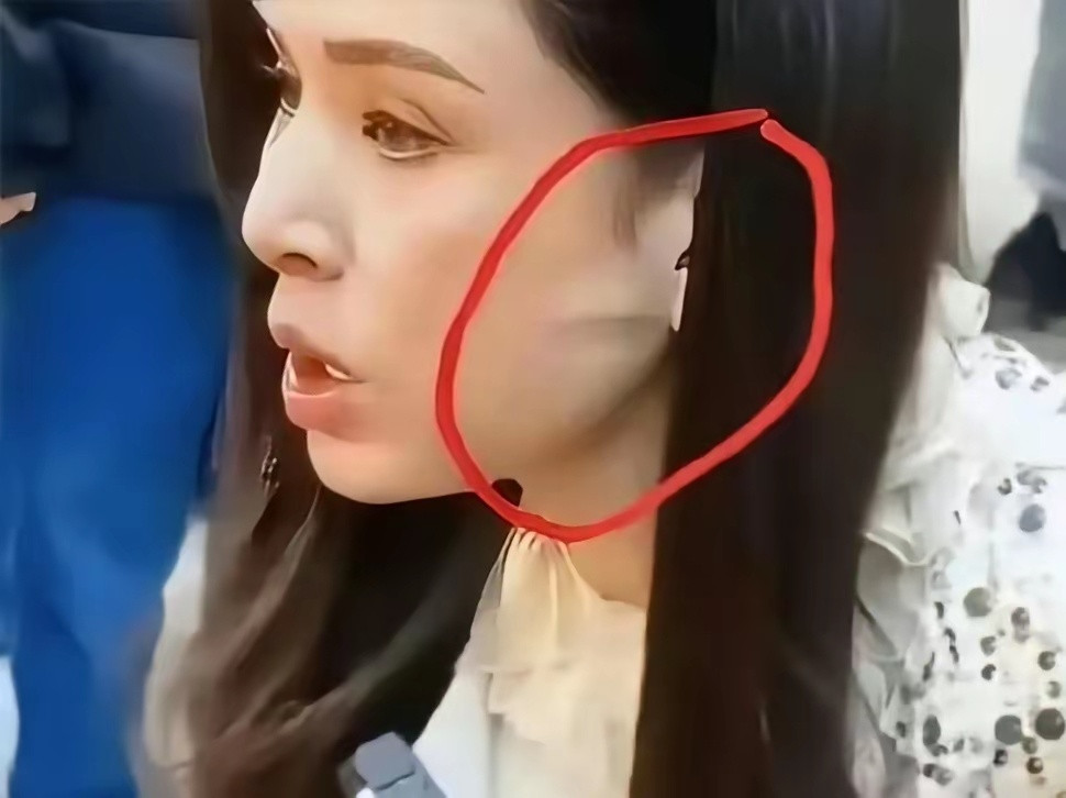 李若彤不是没有医美啊，这耳前凸起的一条线是啥，年纪大了皮肤松弛