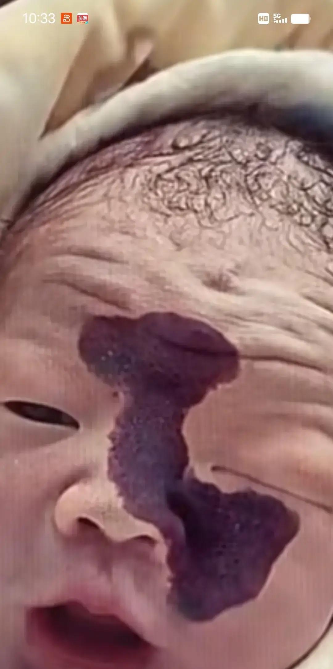 产检照出娃脸上可能带红印，老公当场变脸，劝引产，说不想以后被指指点点。老婆舍不