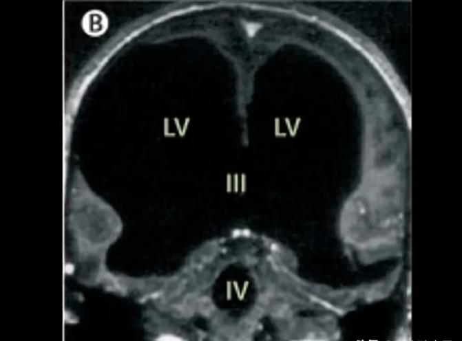 2007年，法国男子去医院检查，医生惊讶发现他的脑子只有薄薄一层，几乎没有大脑，