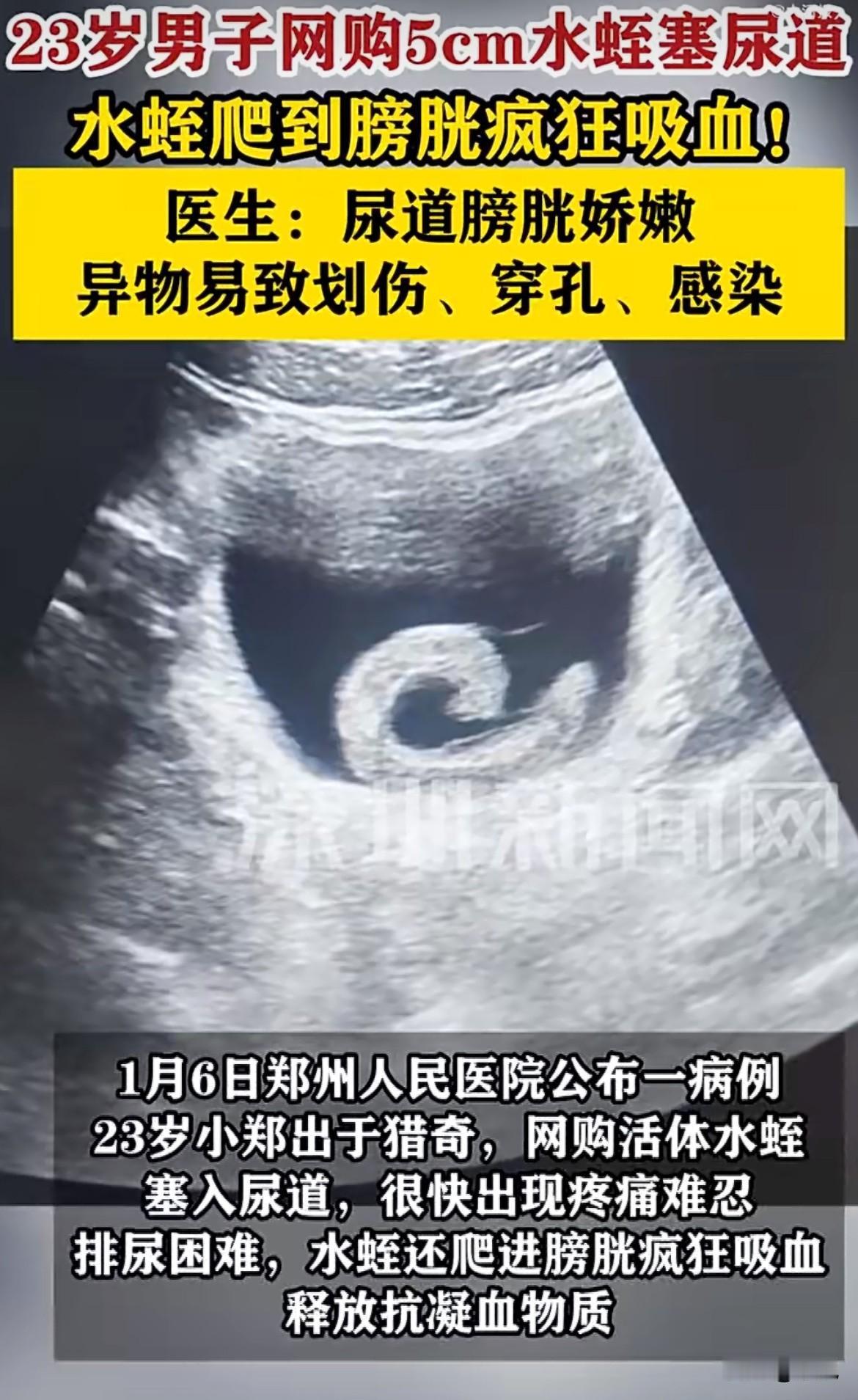 活体水蛭钻进自己尿道，最后在膀胱里吸血为生！医院的诊室里，23岁的小郑蜷着身子