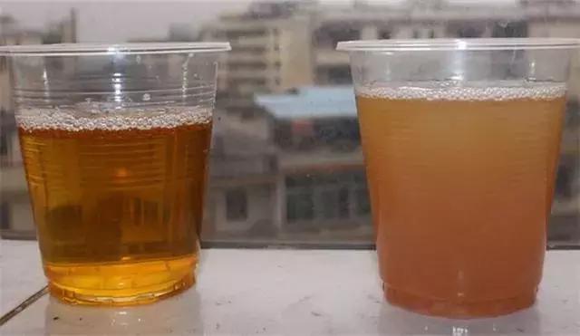 肾内科医生: 尿白蛋白没有微量, 所有肾病患者都该看看