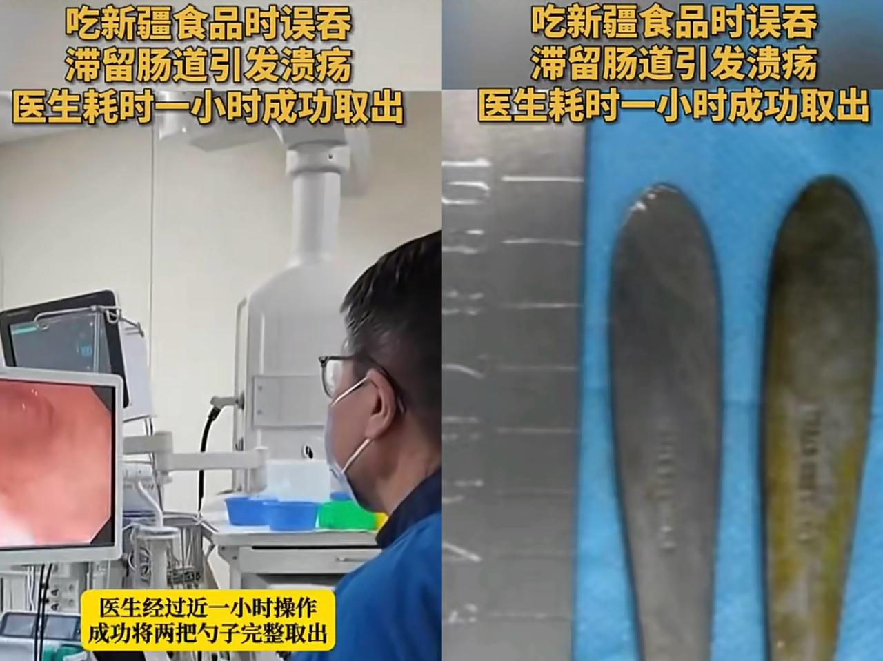 真离谱，12公分的勺子是怎么吞进肚子里的，还吞了两把勺子。刚刚刷新闻，看到南