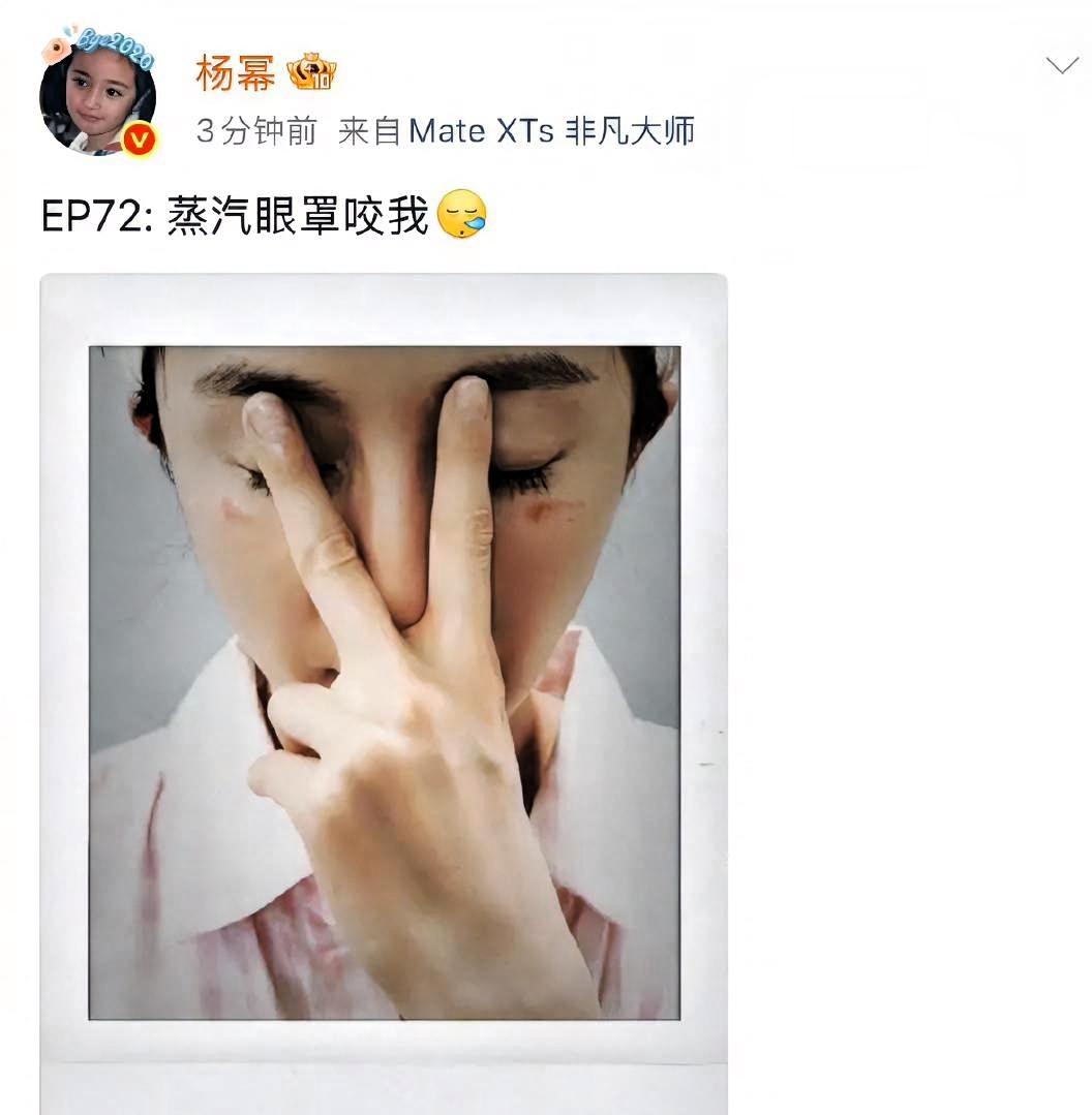 杨幂被蒸汽眼罩烫伤，脸上留下明显红印。她发微博说：“蒸汽眼罩咬我”。评论区都