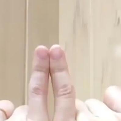 3月13日，江苏一位00后女生分享了自己因不良习惯导致小手指变形的痛苦经历。原来