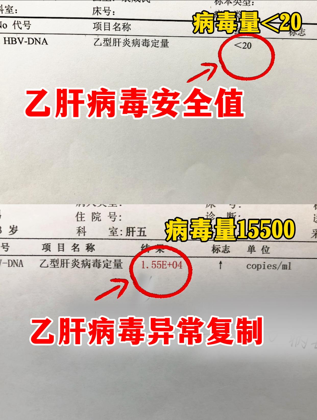 乙肝病毒低于这个标准，恭喜你，病毒不再复制！ 1.HBV DNA检测不...