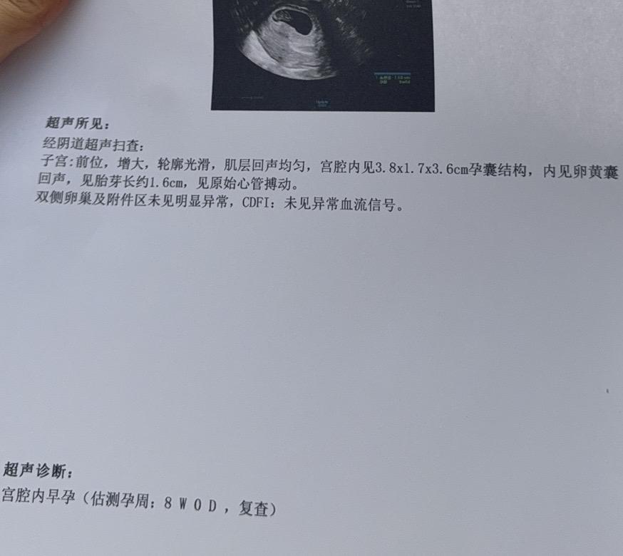 我的宝宝8周啦 新鲜出炉的b超单，要好好长大哦