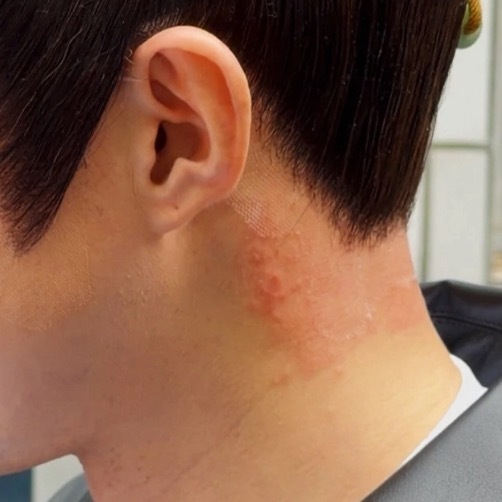 好像越来越严重了……为啥呀？是胶的问题吗？（叶老师还把领子立起来挡住了，隐隐担心