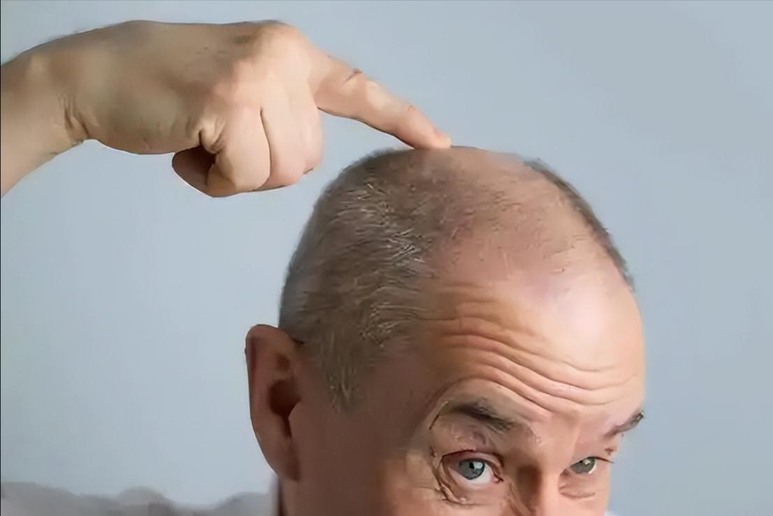 男性能活多久，看头发就知？提醒：若有这3症状，尽早引起重视！有些男人，年纪轻