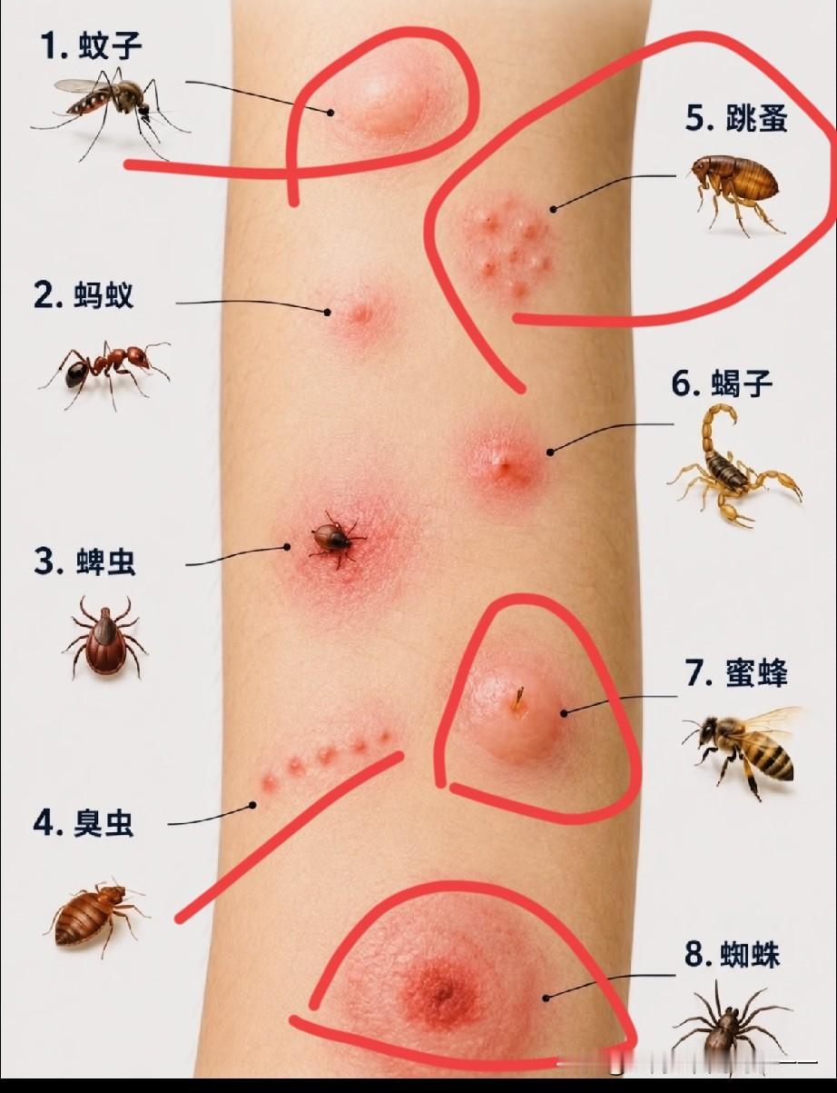 终于知道被什么虫子咬了？
