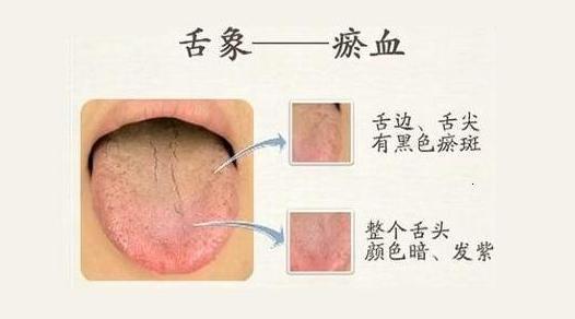 血淤了, 吃点啥? 这五种药膳, 可能是最靠谱的