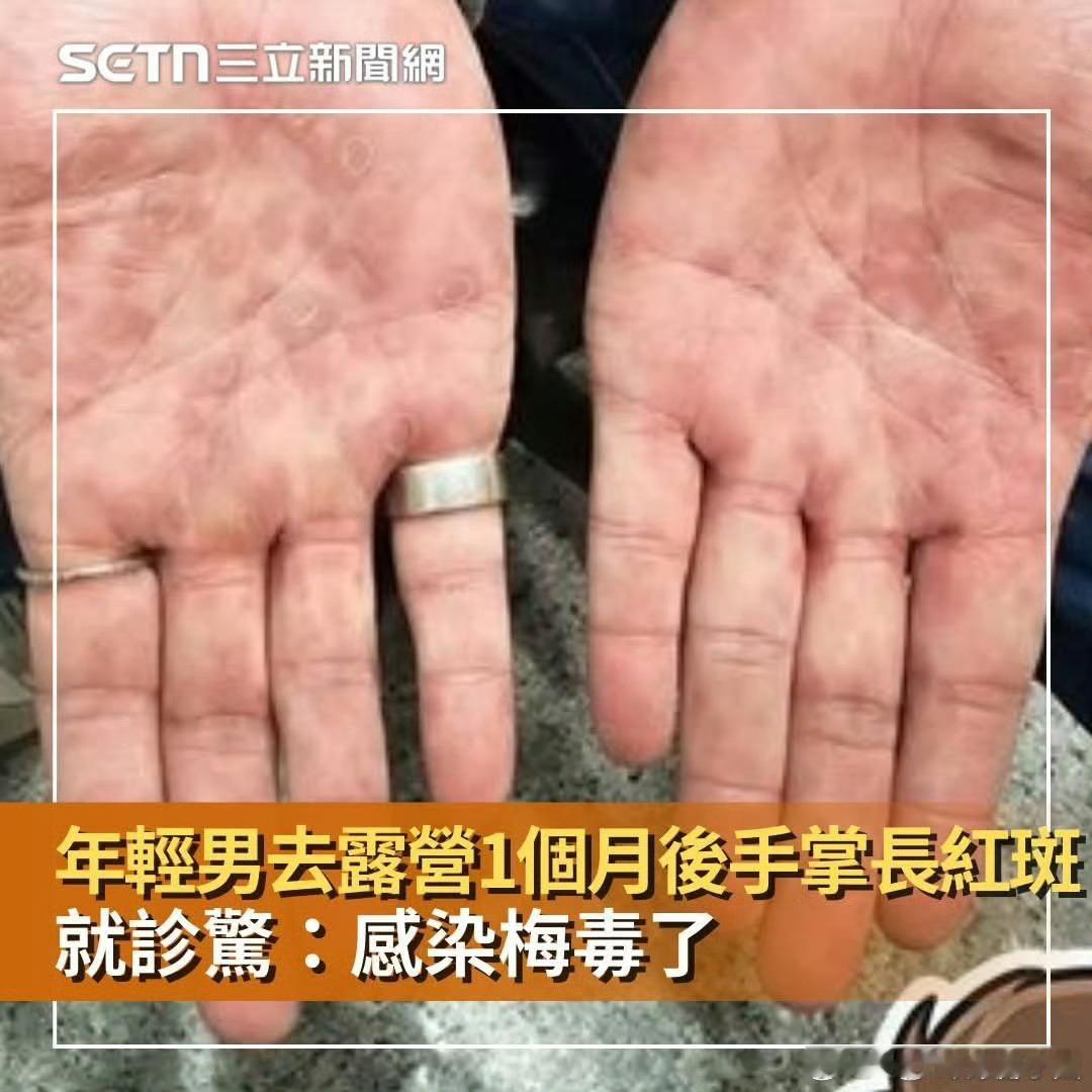 共用浴巾/马桶也不会感染梅毒，望周知